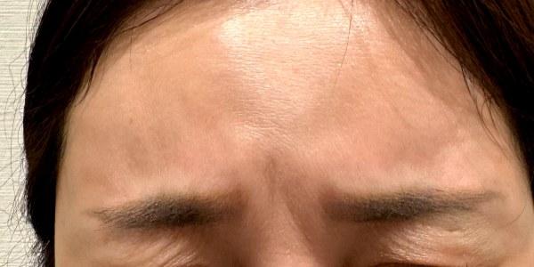 症例2：眉間の細かいシワの改善（治療前）