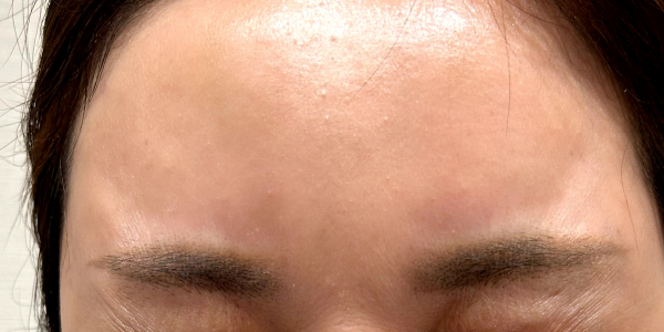 症例2：眉間の細かいシワの改善（治療から1ヶ月）