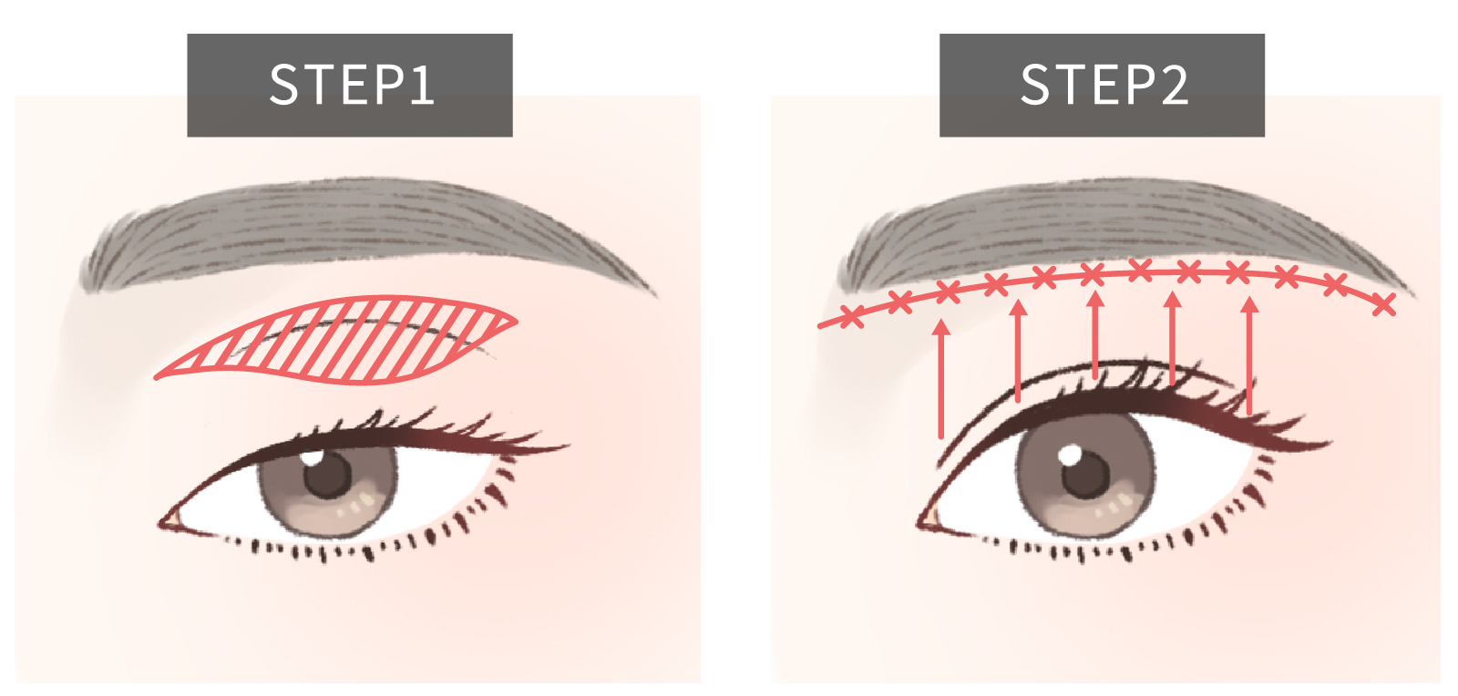 眉下切開の施術STEP